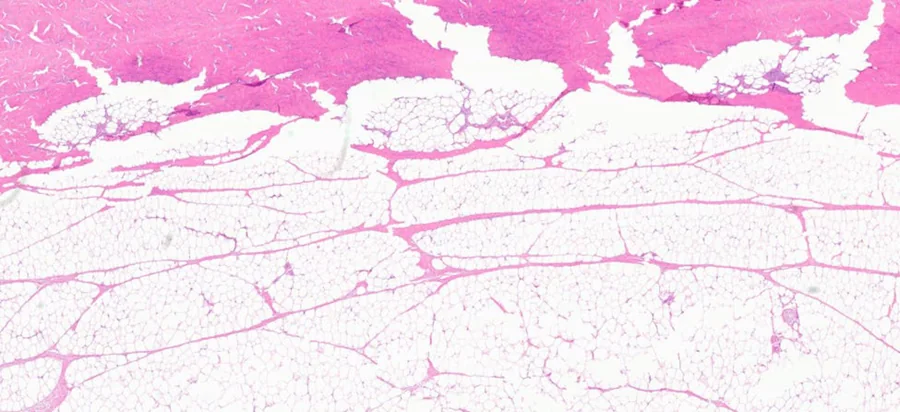 Figure 5 from the study: H&E stained section of treated ex vivo porcine skin, dermal fibrous tissue fragmented