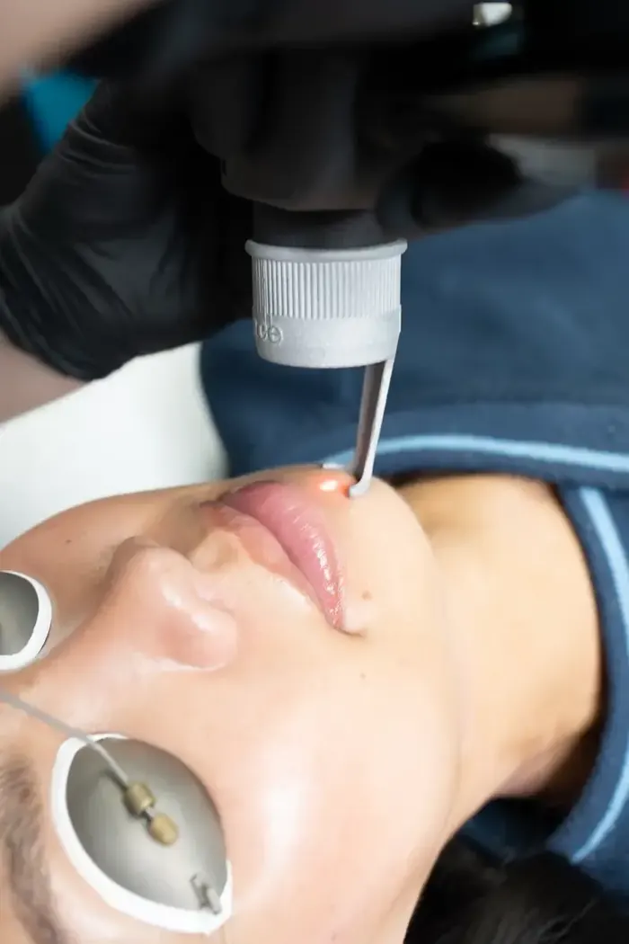 Selene Face tip treating the perioral area