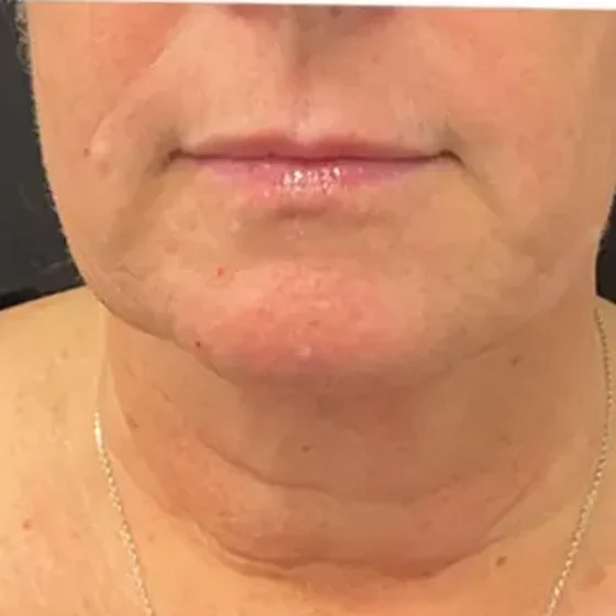 Lower face and neck after Selene fractional CO₂ laser treatment