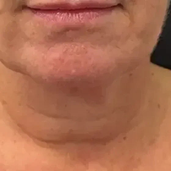 Lower face and neck before Selene fractional CO₂ laser treatment