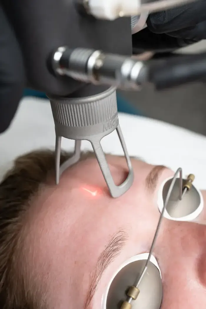 Selene Micro tip during a fractional CO₂ pass on a patient's forehead